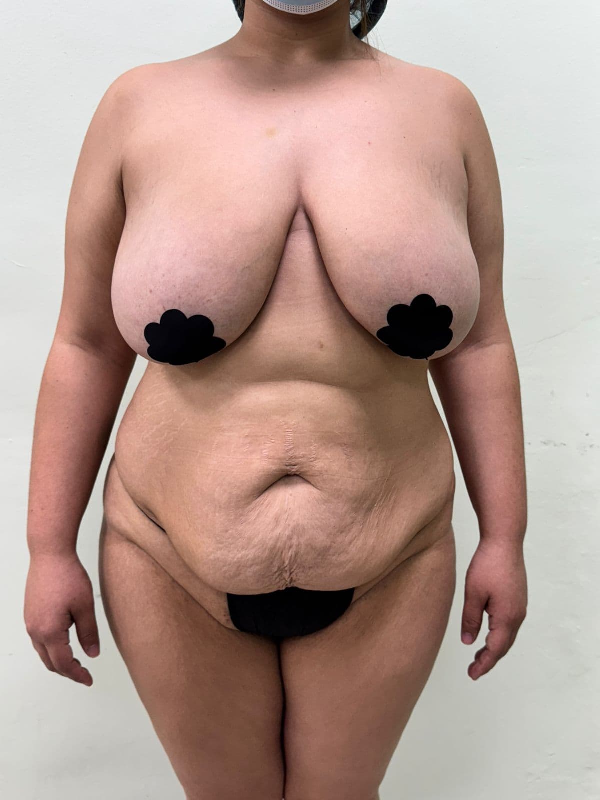 Abdominoplastia - Imagen 19