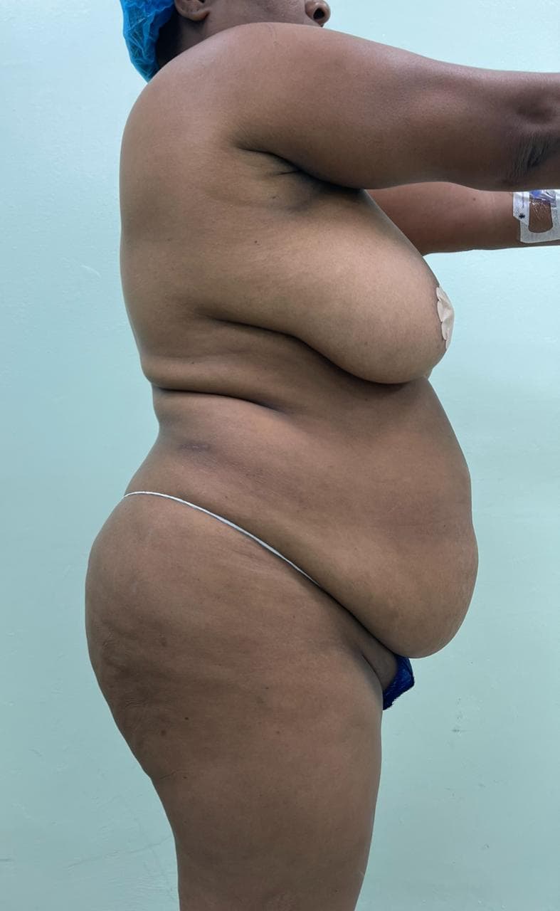 Abdominoplastia - Imagen 21