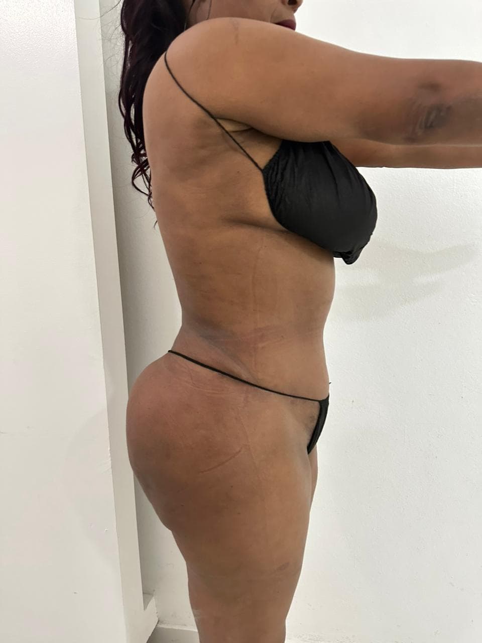 Abdominoplastia - Imagen 22