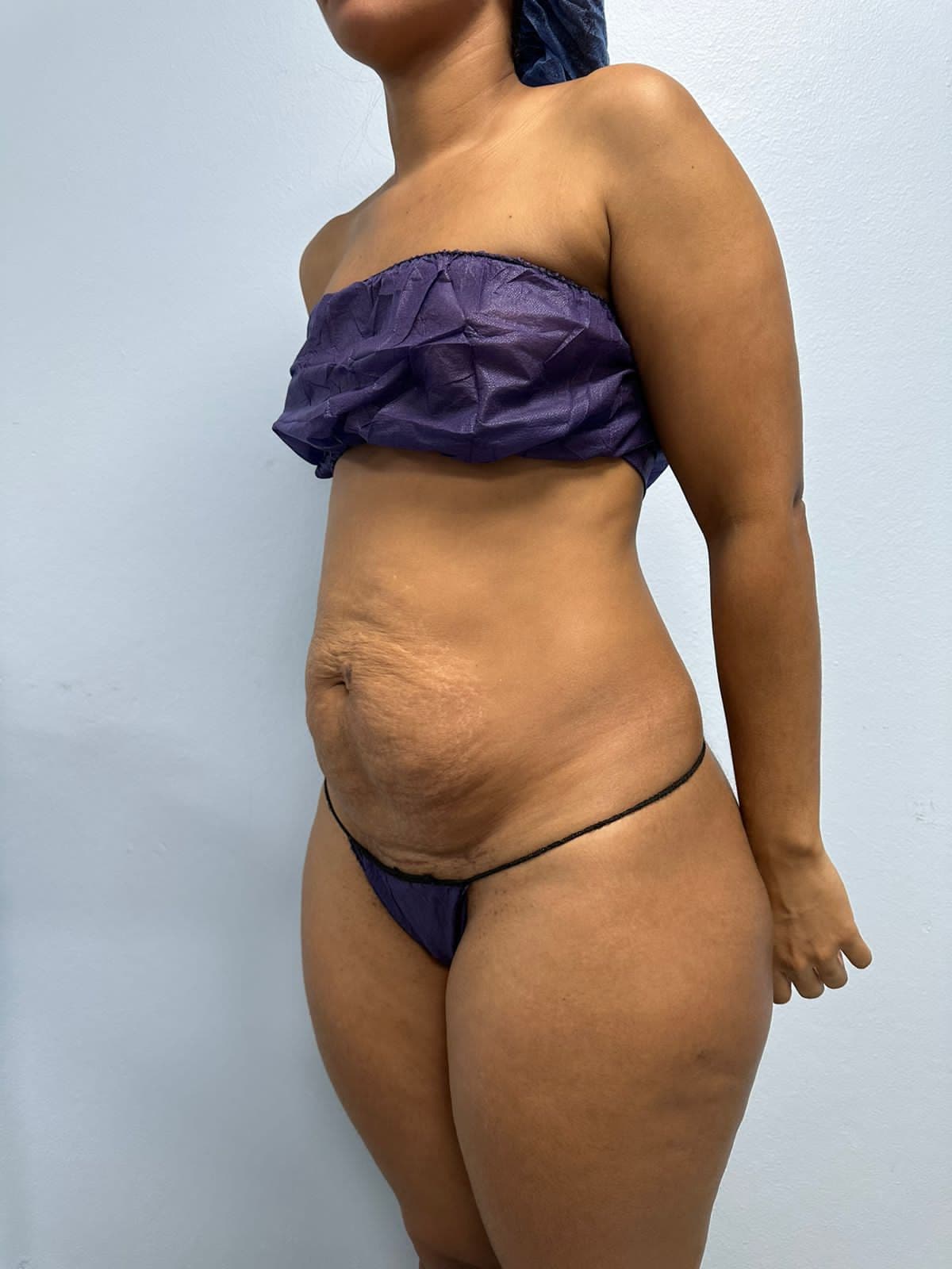 Abdominoplastia - Imagen 23