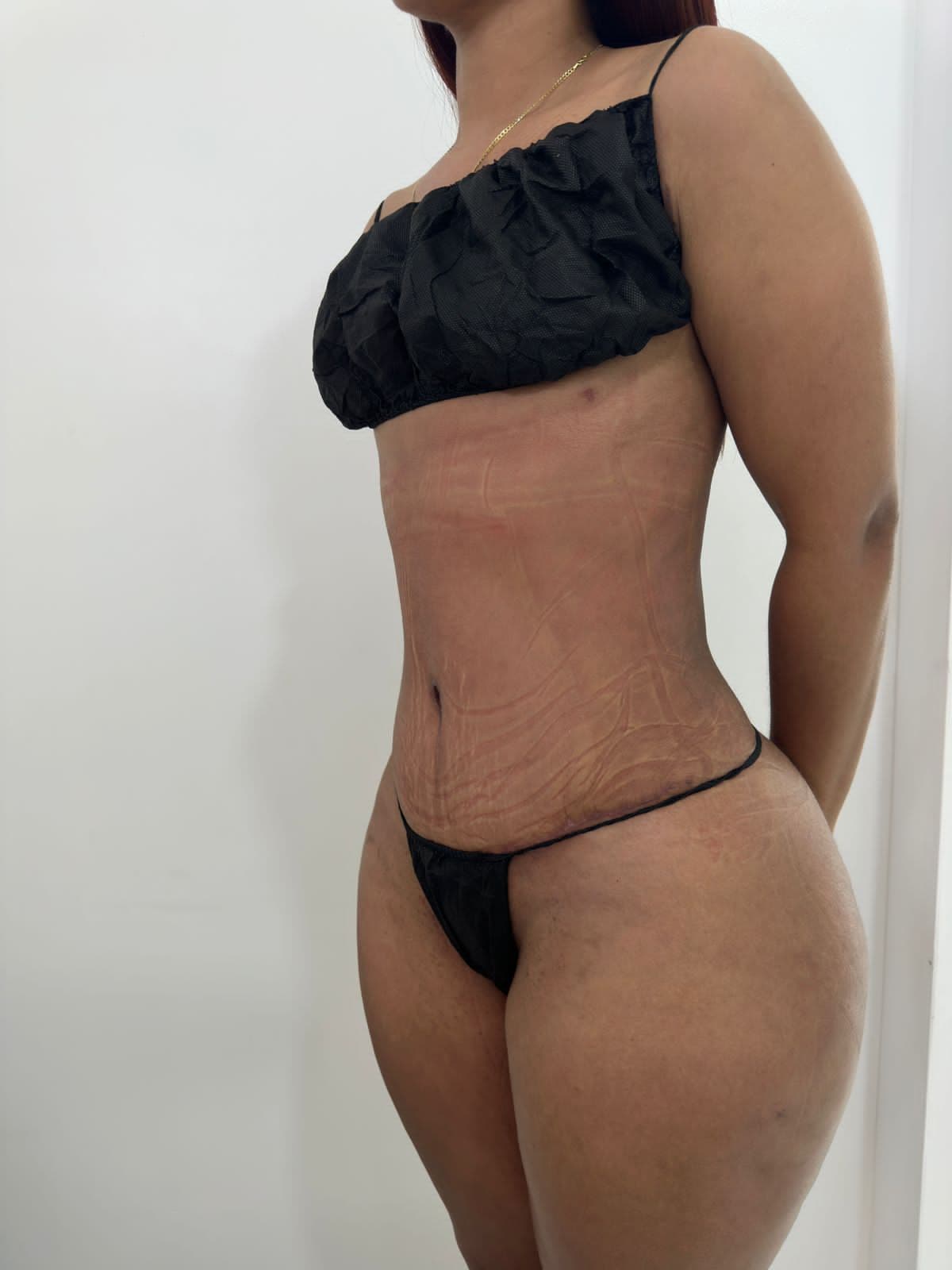 Abdominoplastia - Imagen 24