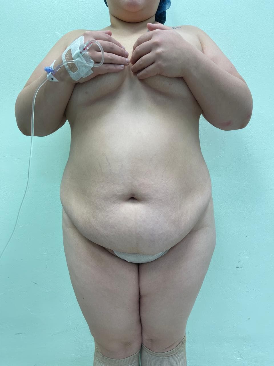Abdominoplastia - Imagen 25