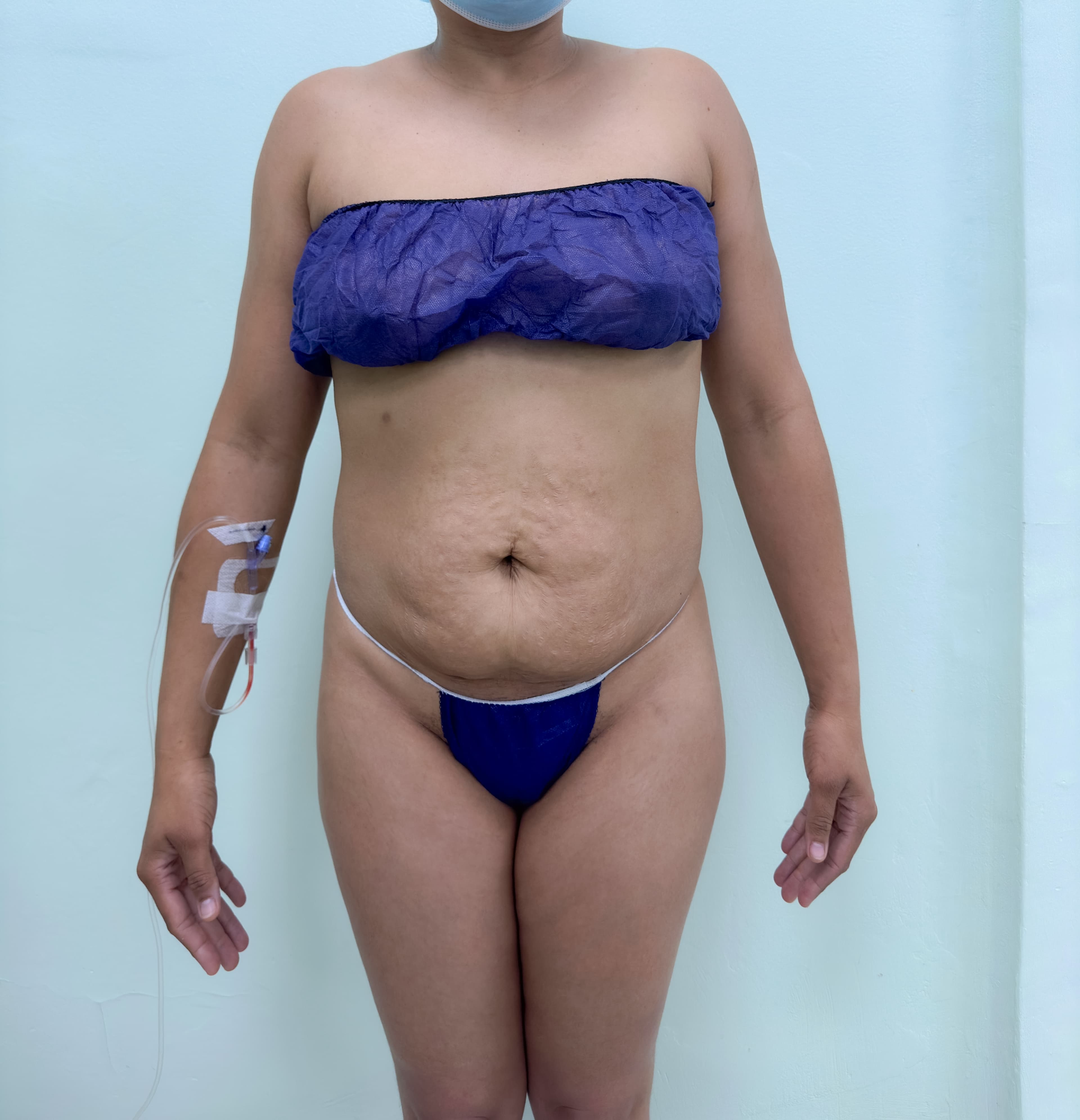 Abdominoplastia - Imagen 27