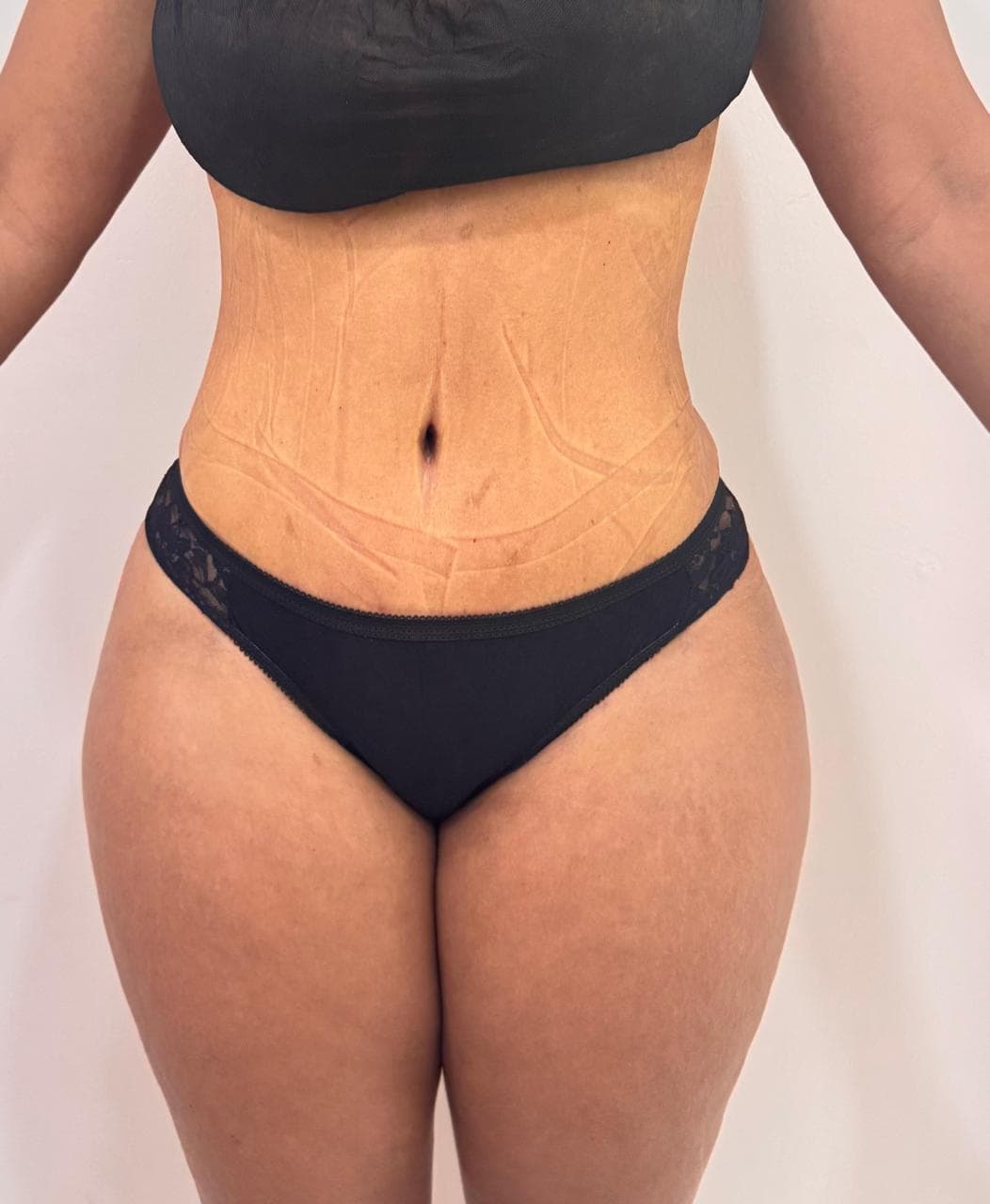 Abdominoplastia - Imagen 32