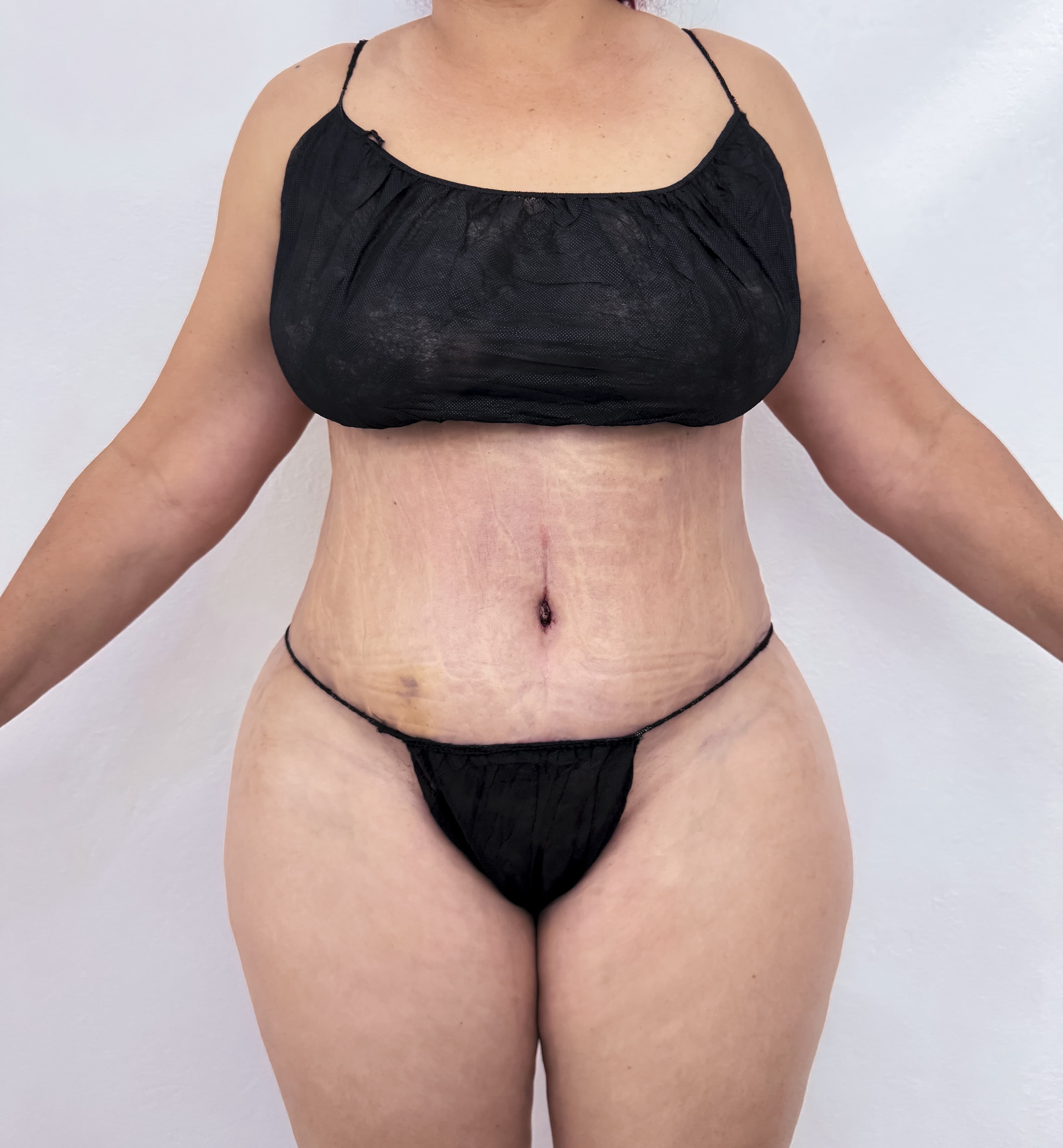 Abdominoplastia - Imagen 4