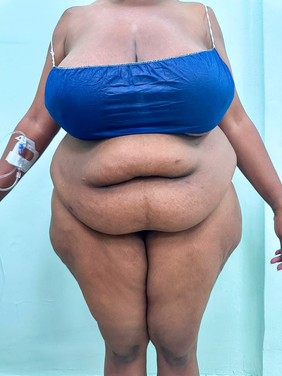 Abdominoplastia - Imagen 7