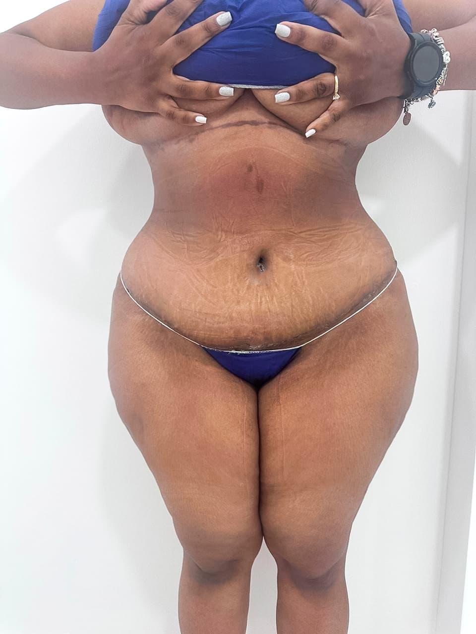 Abdominoplastia - Imagen 8