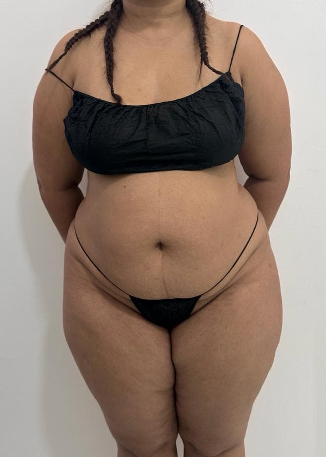 Abdominoplastia - Imagen 9