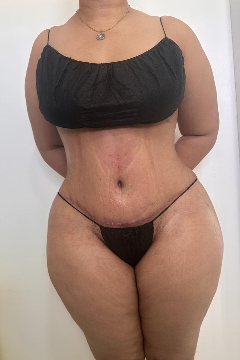 Abdominoplastia - Imagen 10