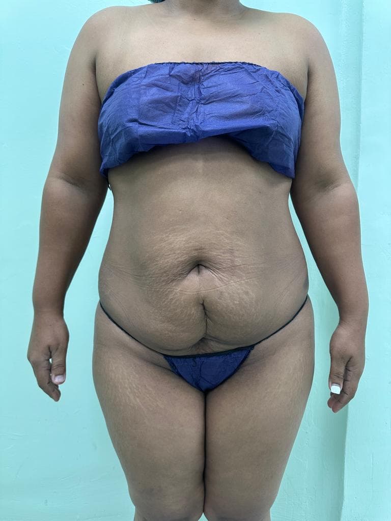 Abdominoplastia - Imagen 11