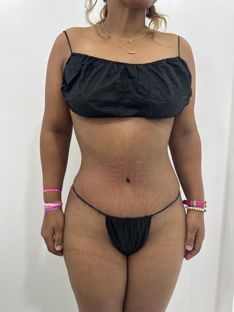 Abdominoplastia - Imagen 12