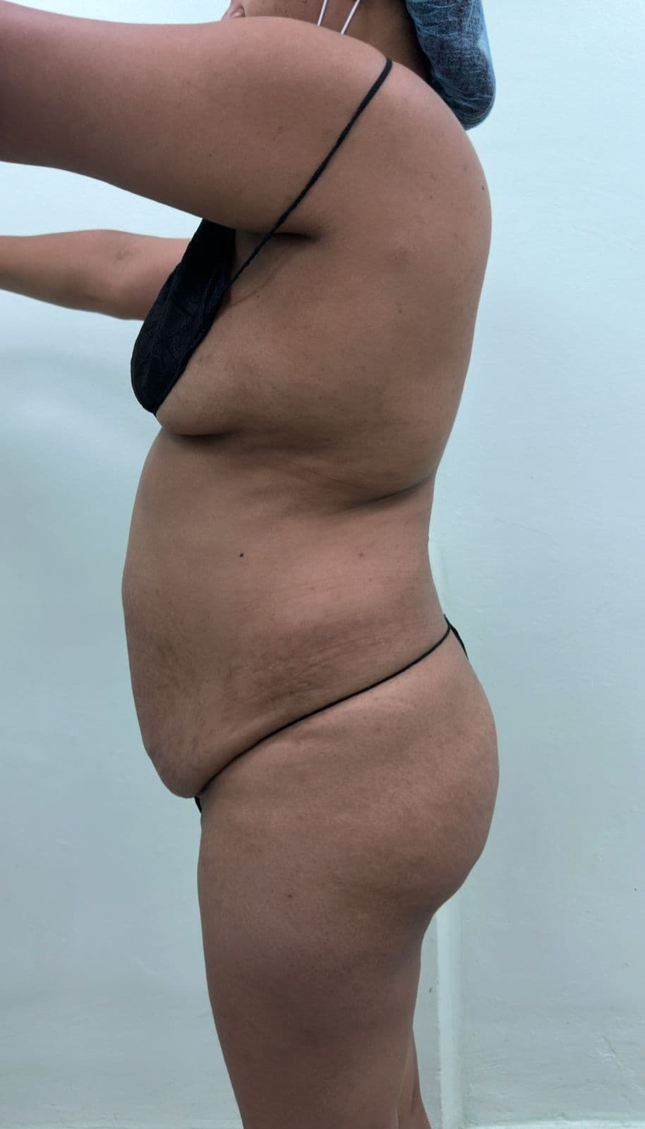 Abdominoplastia - Imagen 13