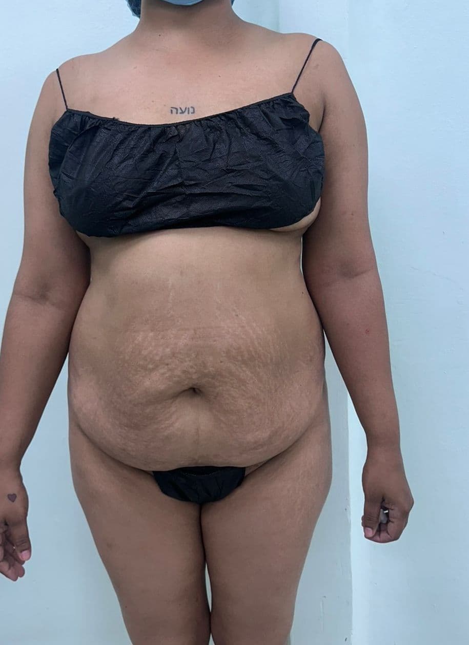 Abdominoplastia - Imagen 15