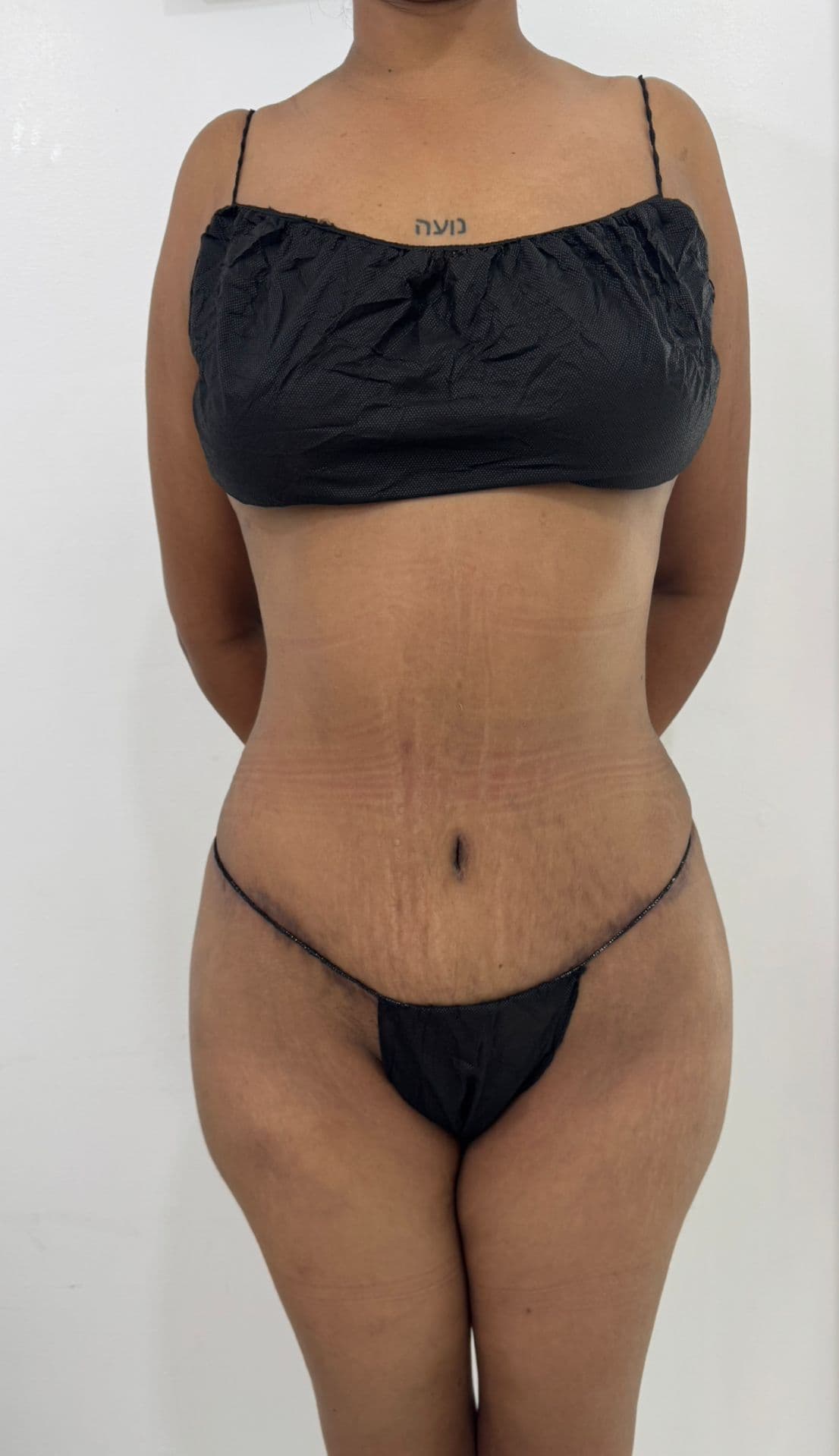 Abdominoplastia - Imagen 16