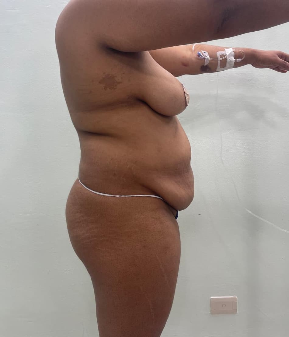 Abdominoplastia - Imagen 17