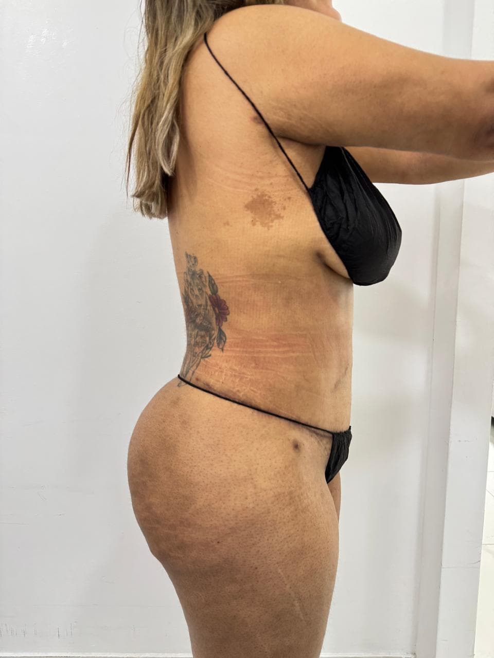 Abdominoplastia - Imagen 18