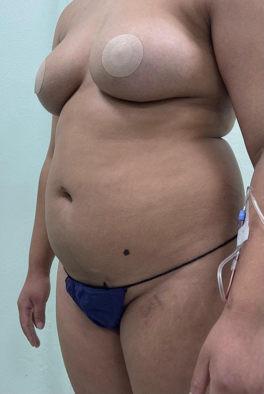 Lipoescultura - Antes