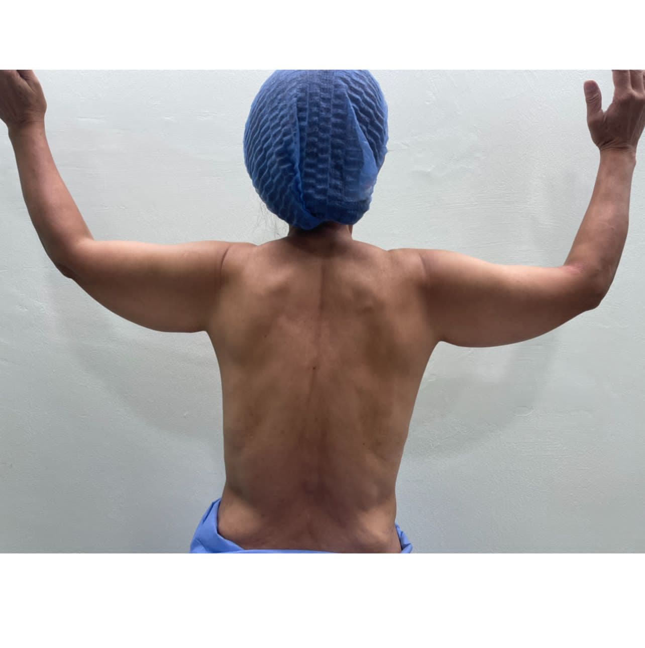 Lipoescultura - Antes