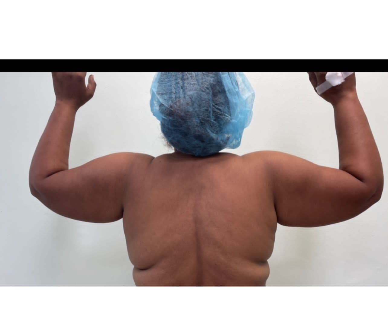 Lipoescultura - Antes