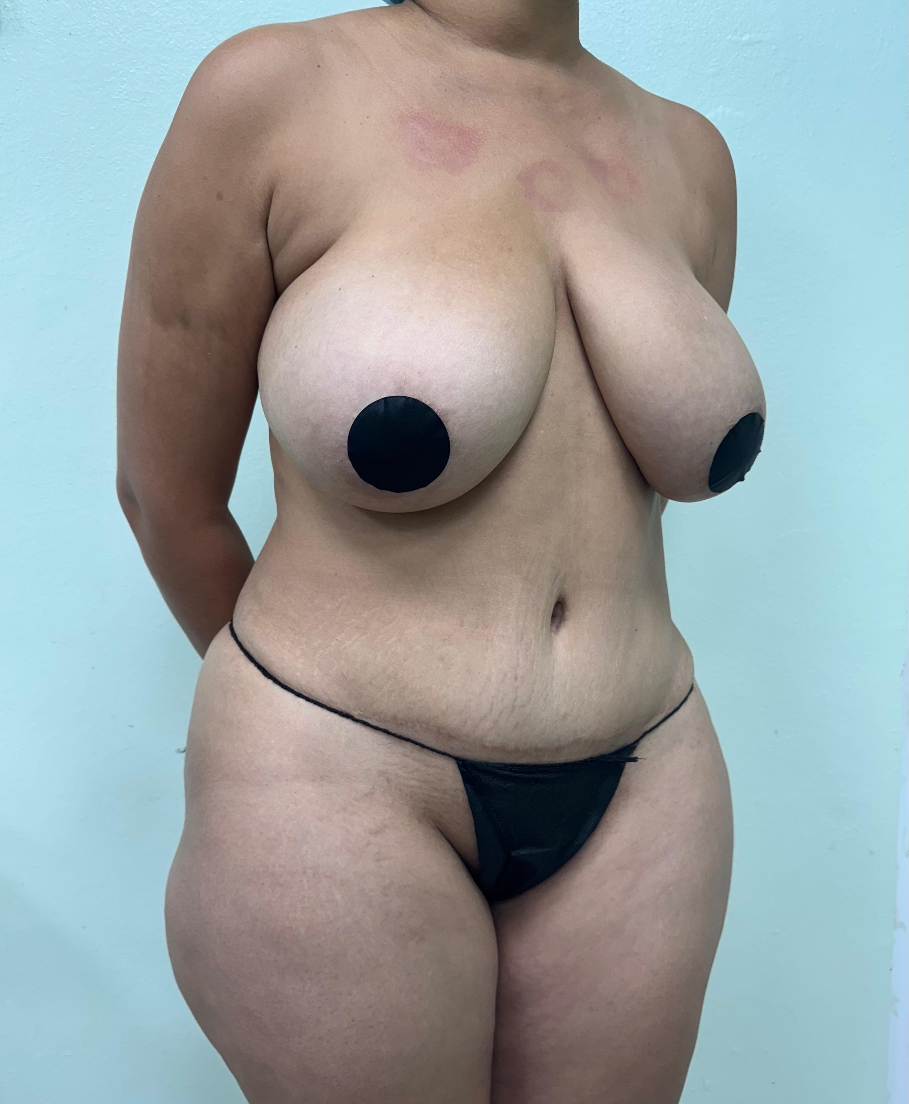Lipoescultura - Antes