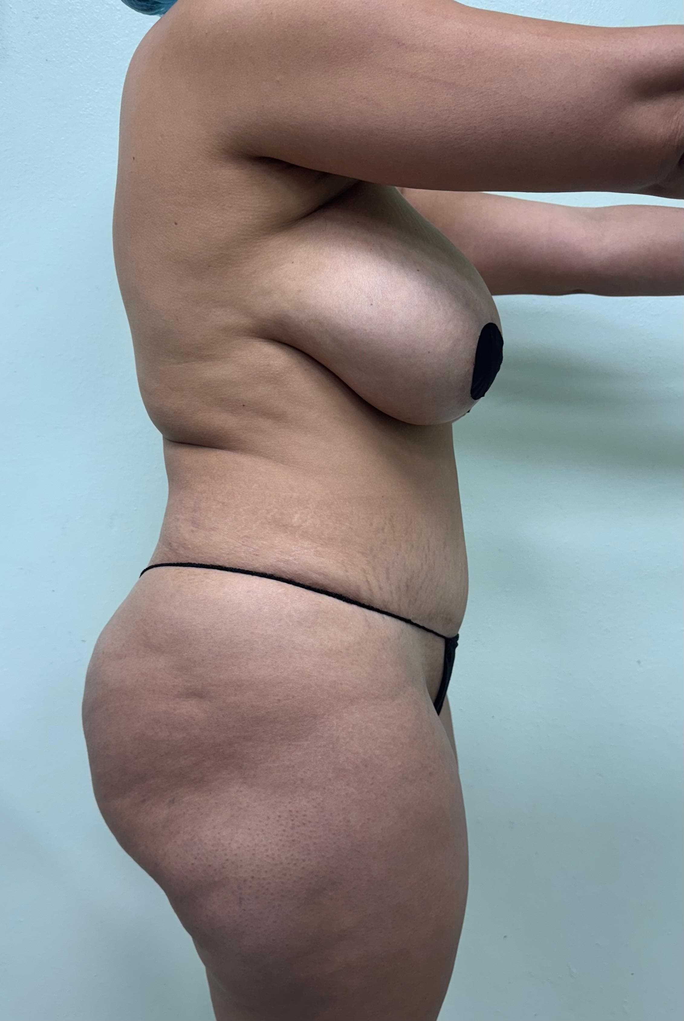 Lipoescultura - Antes