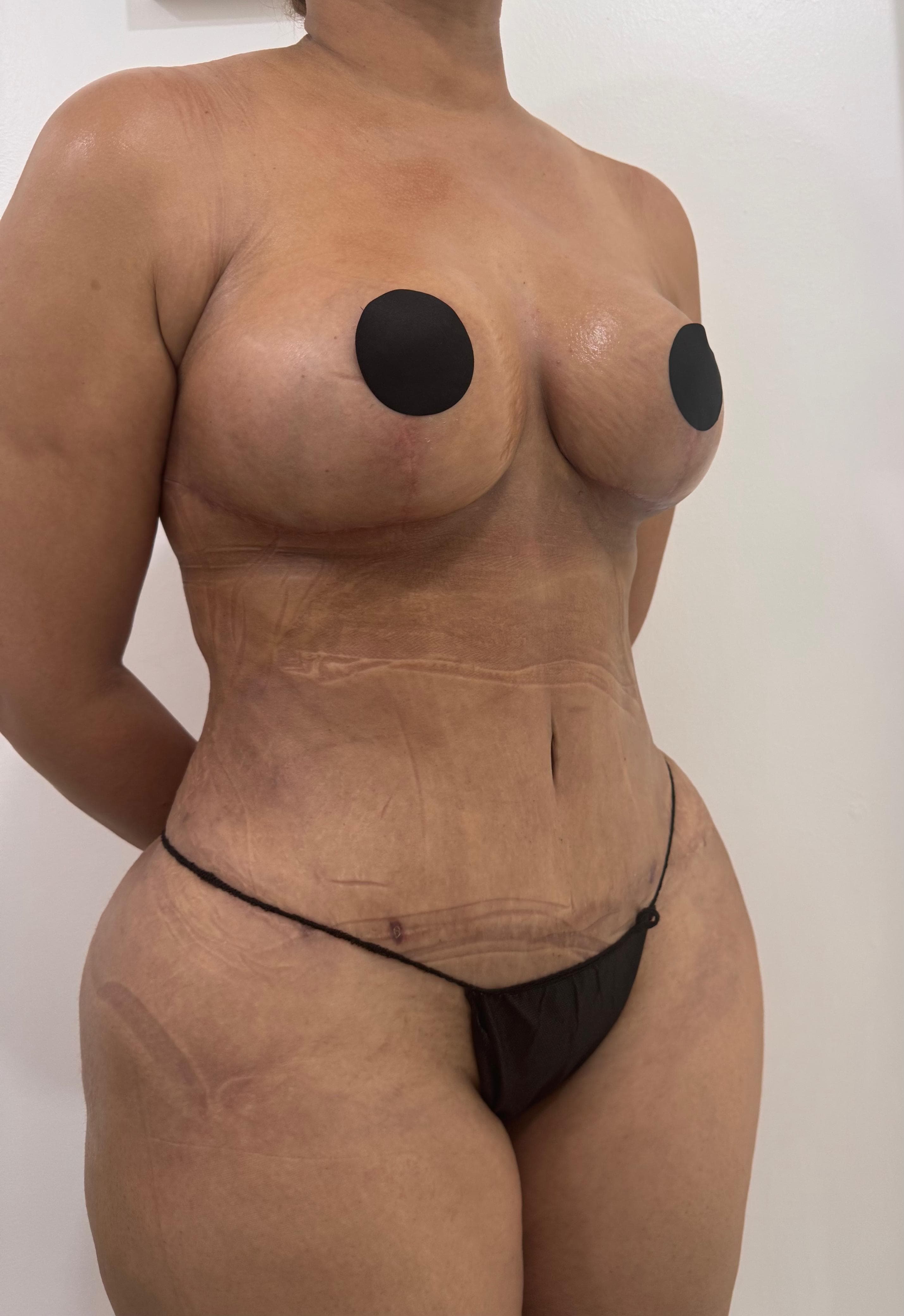 Lipoescultura - Después