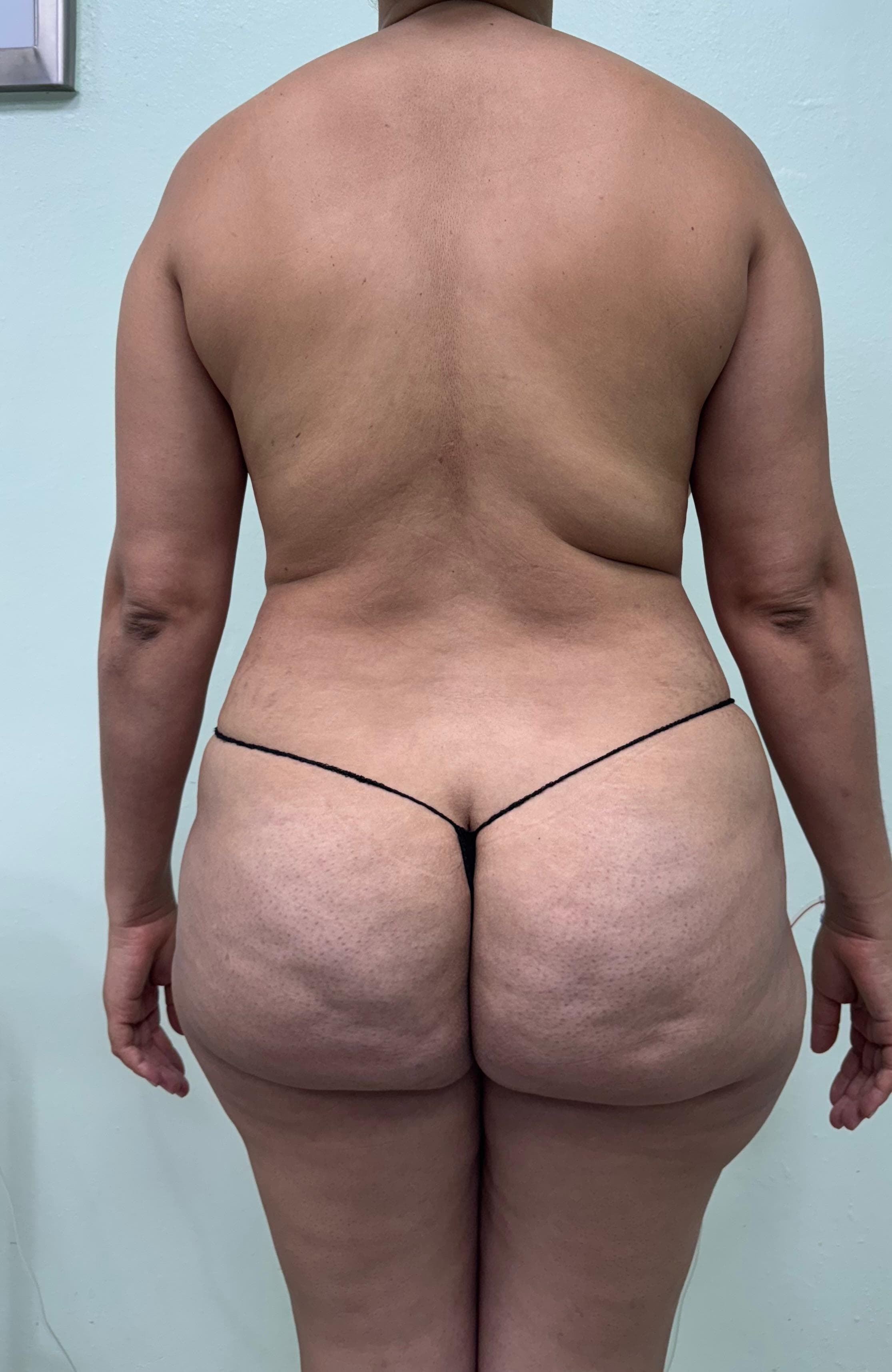 Lipoescultura - Antes