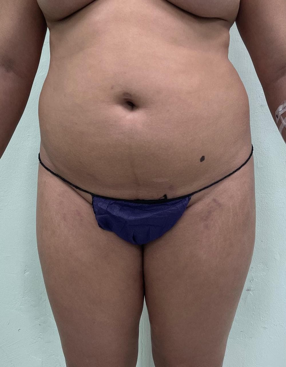 Lipoescultura - Antes