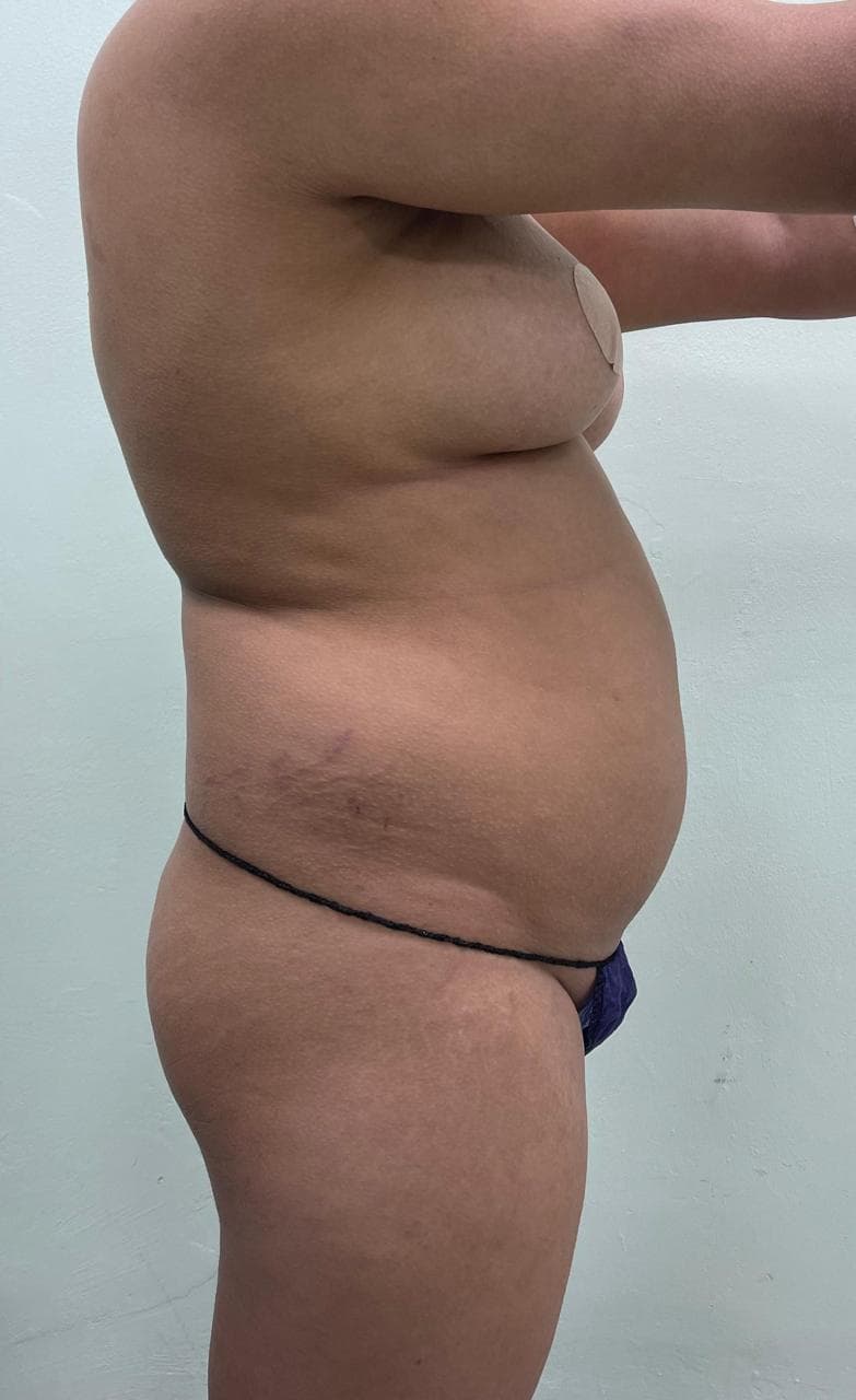 Lipoescultura - Antes