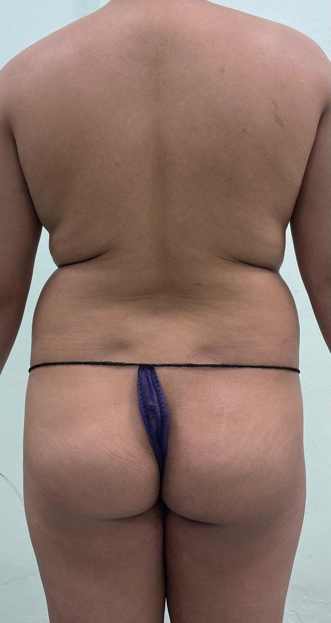 Lipoescultura - Antes