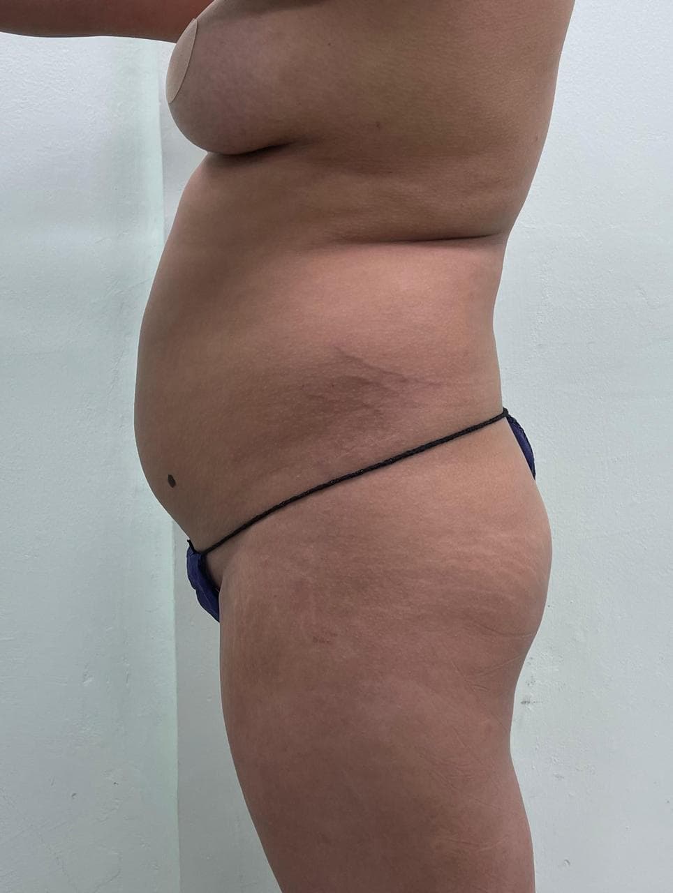 Lipoescultura - Antes