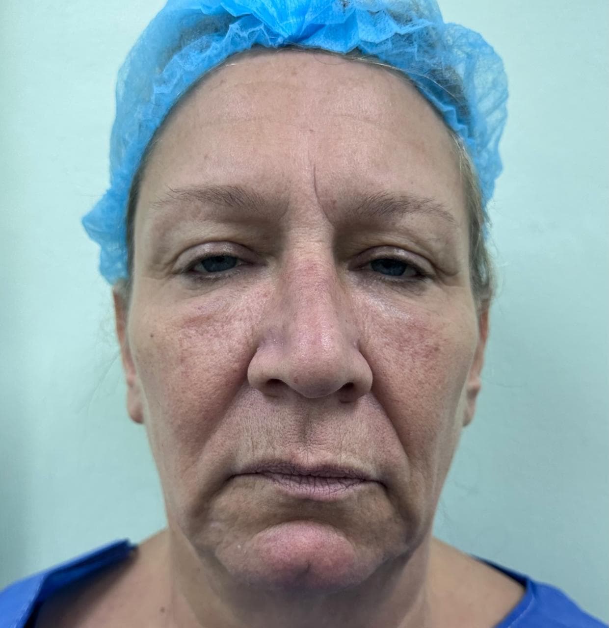 Lifting Facial - Antes