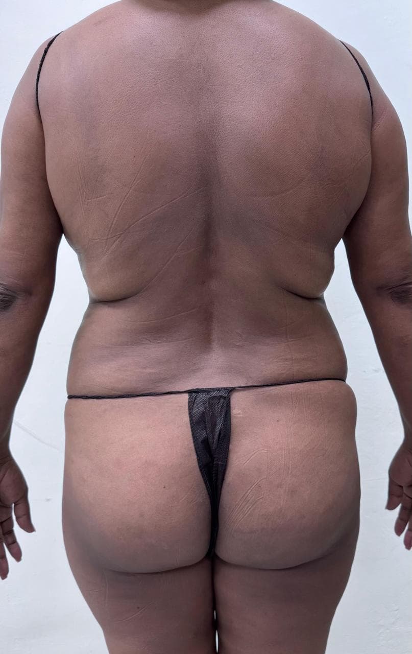 Lipoescultura de Espalda - Antes