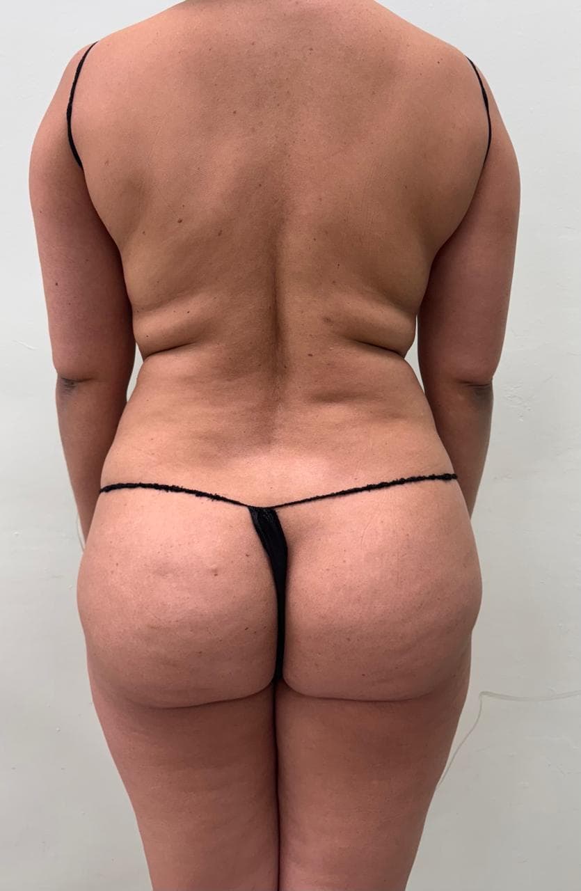 Lipoescultura de Espalda - Antes