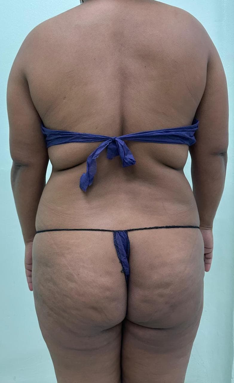 Lipoescultura de Espalda - Antes