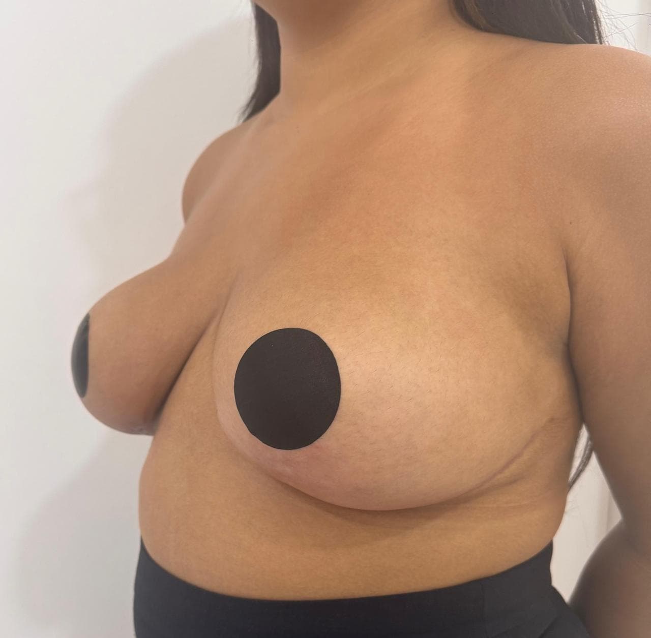 Mamoplastia de Reducción - Después