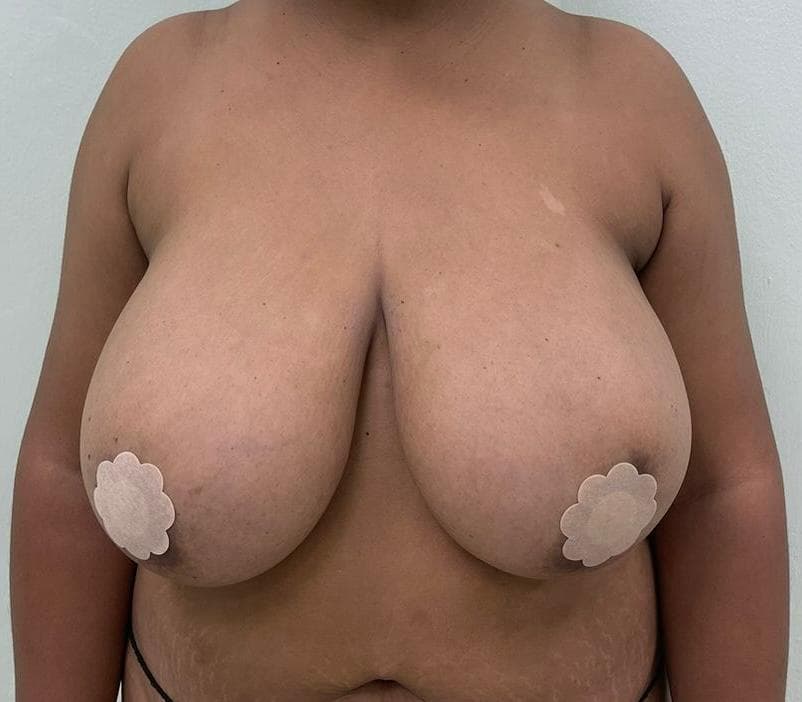Mamoplastia de Reducción - Antes