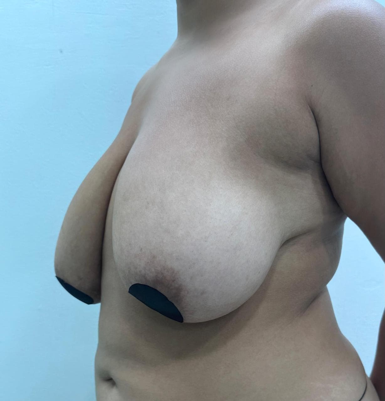 Mamoplastia de Reducción - Después