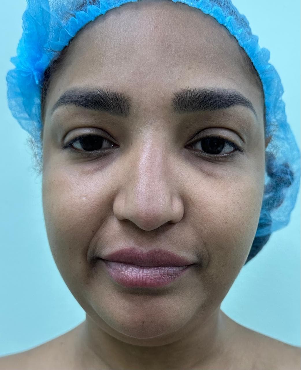 Rinoplastia - Antes