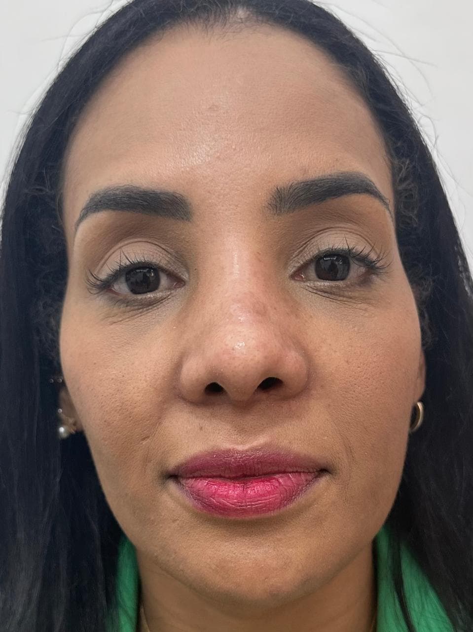 Rinoplastia - Antes