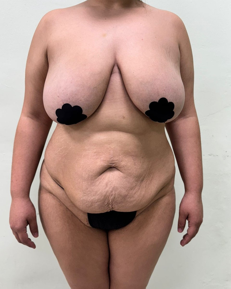 Abdominoplastia - Antes #9