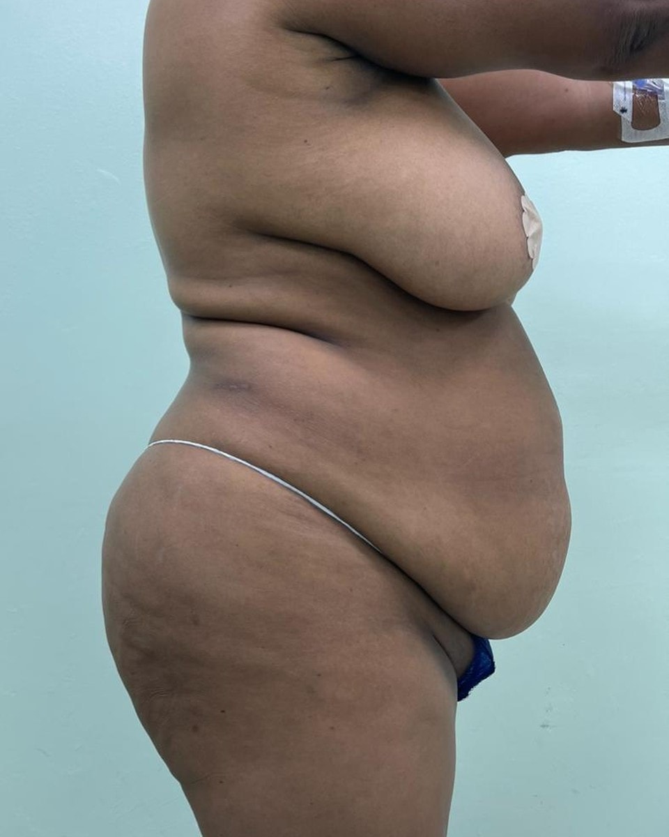 Abdominoplastia - Antes