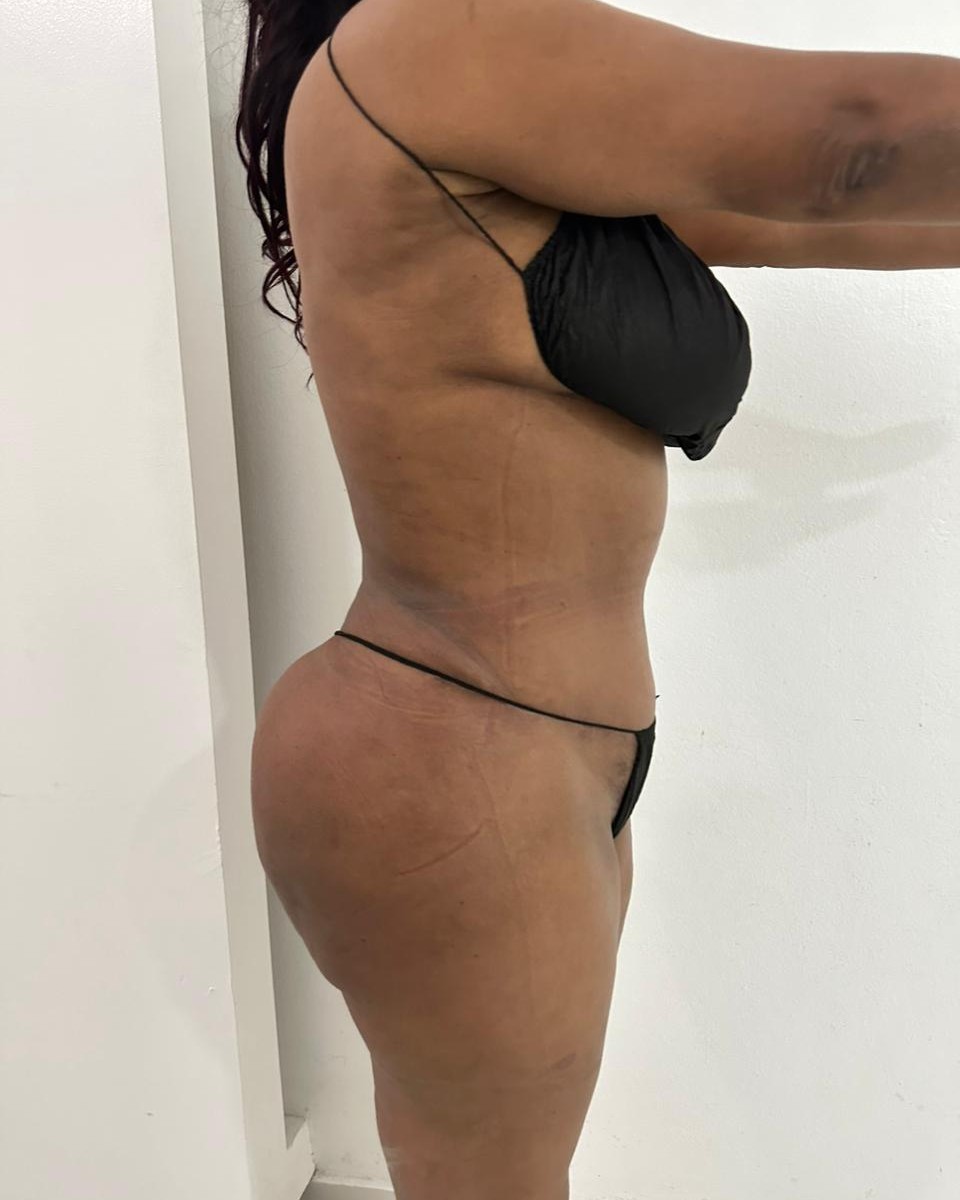 Abdominoplastia - Después #10