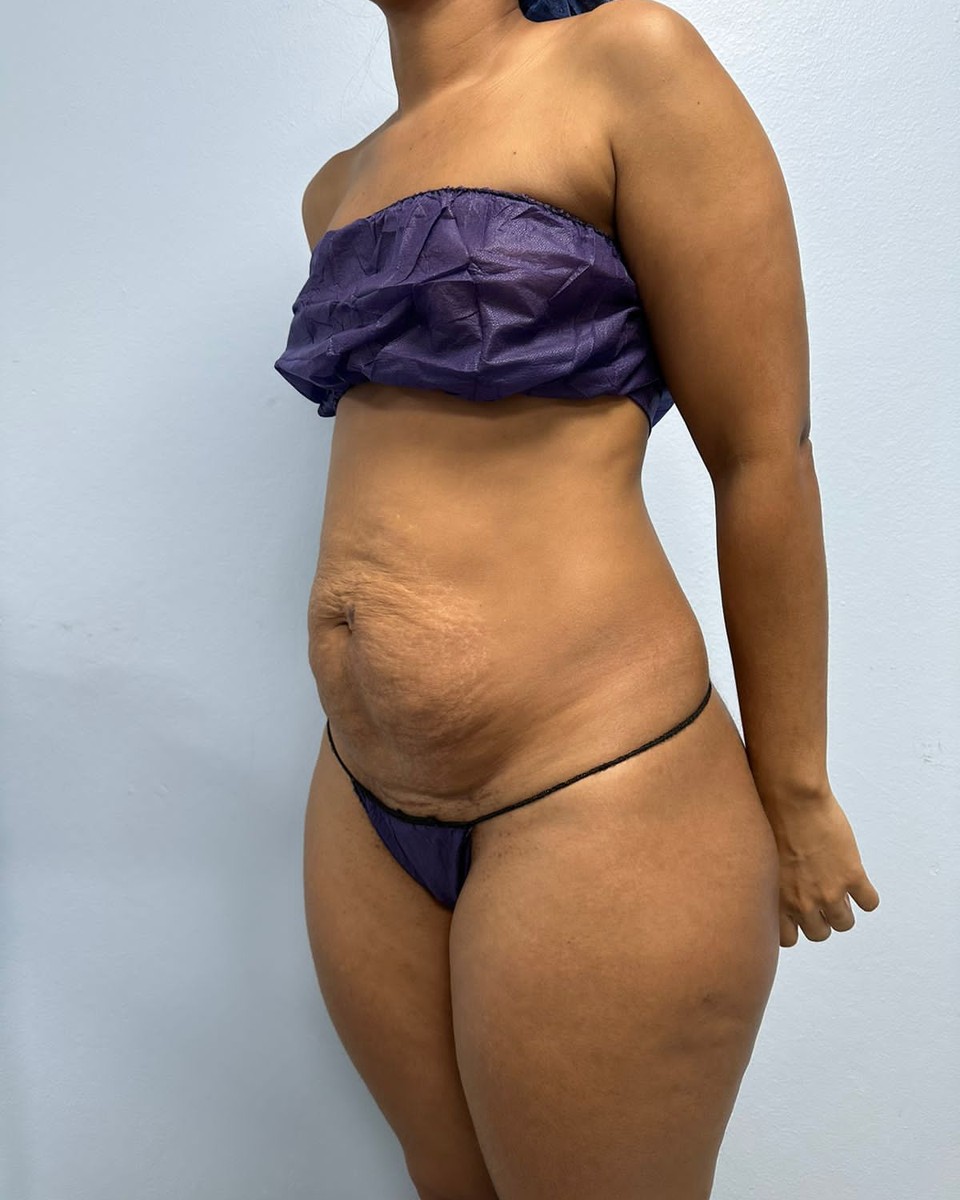 Abdominoplastia - Antes #11