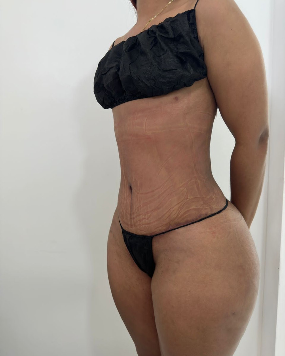 Abdominoplastia - Después #11