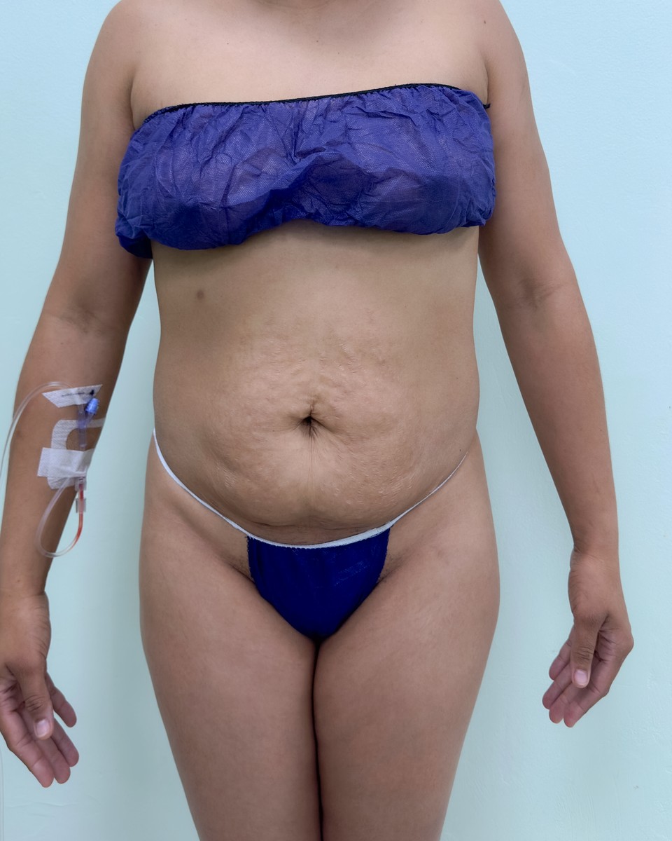 Abdominoplastia - Antes #12