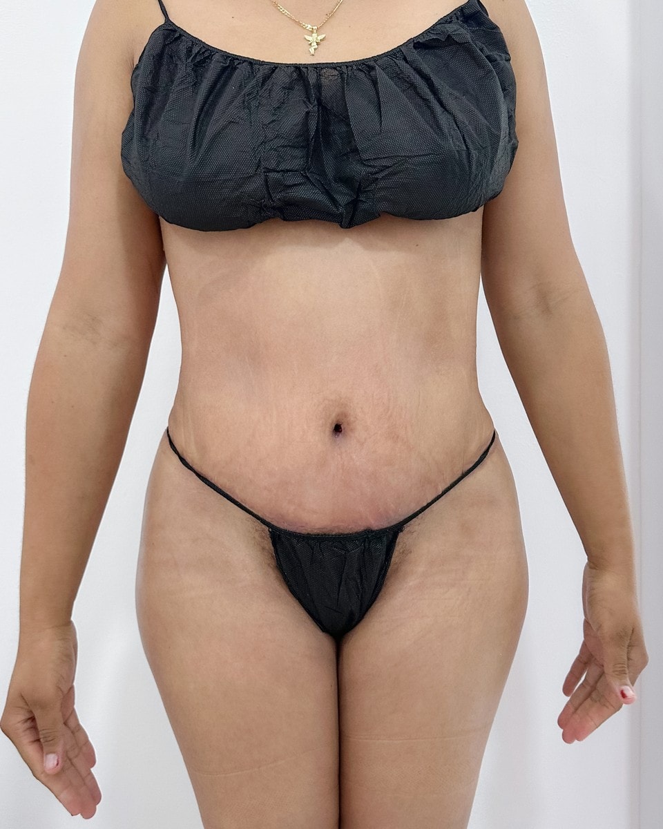 Abdominoplastia - Después