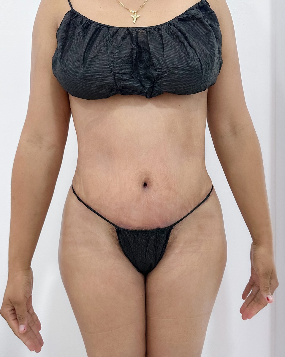 Abdominoplastia - Después #12