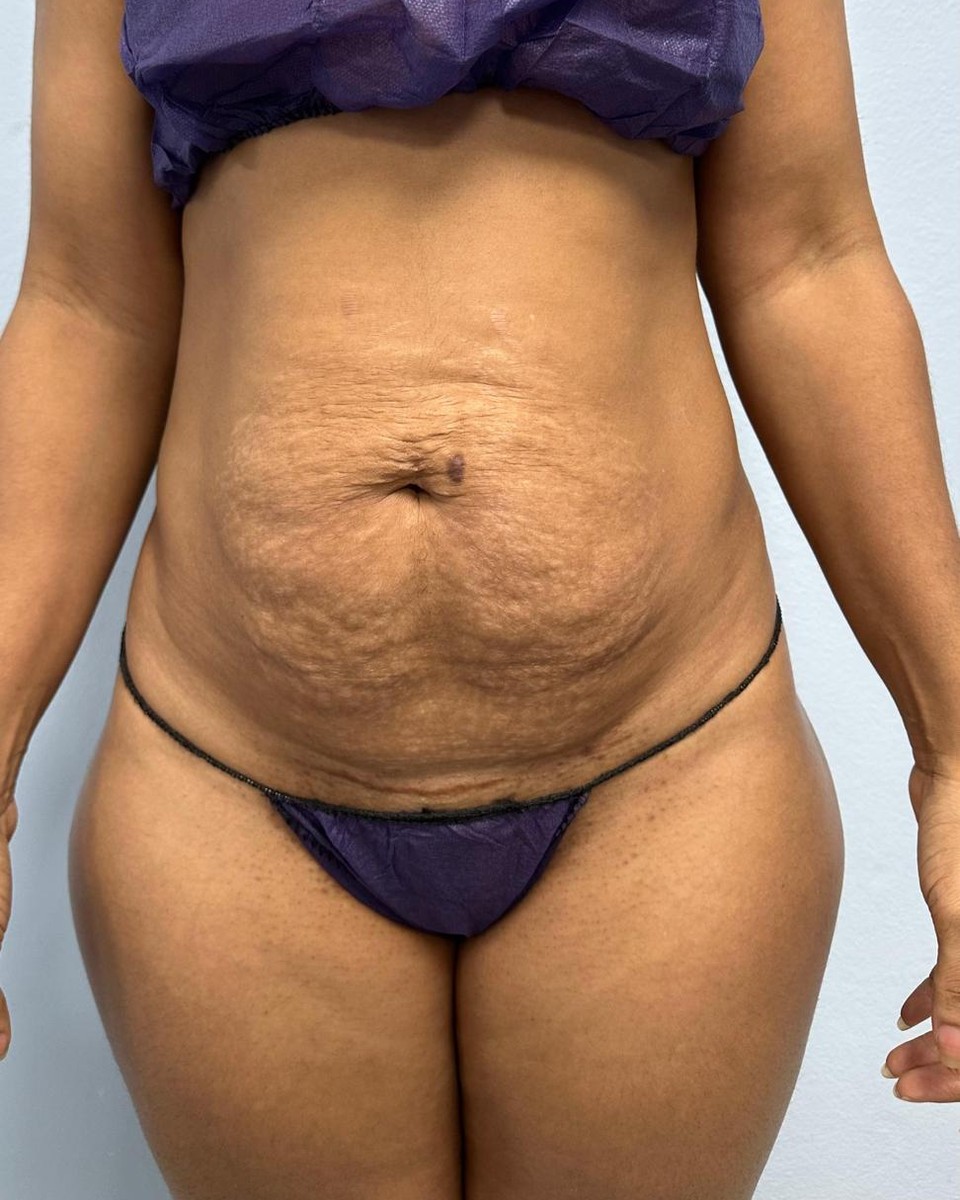 Abdominoplastia - Antes #13