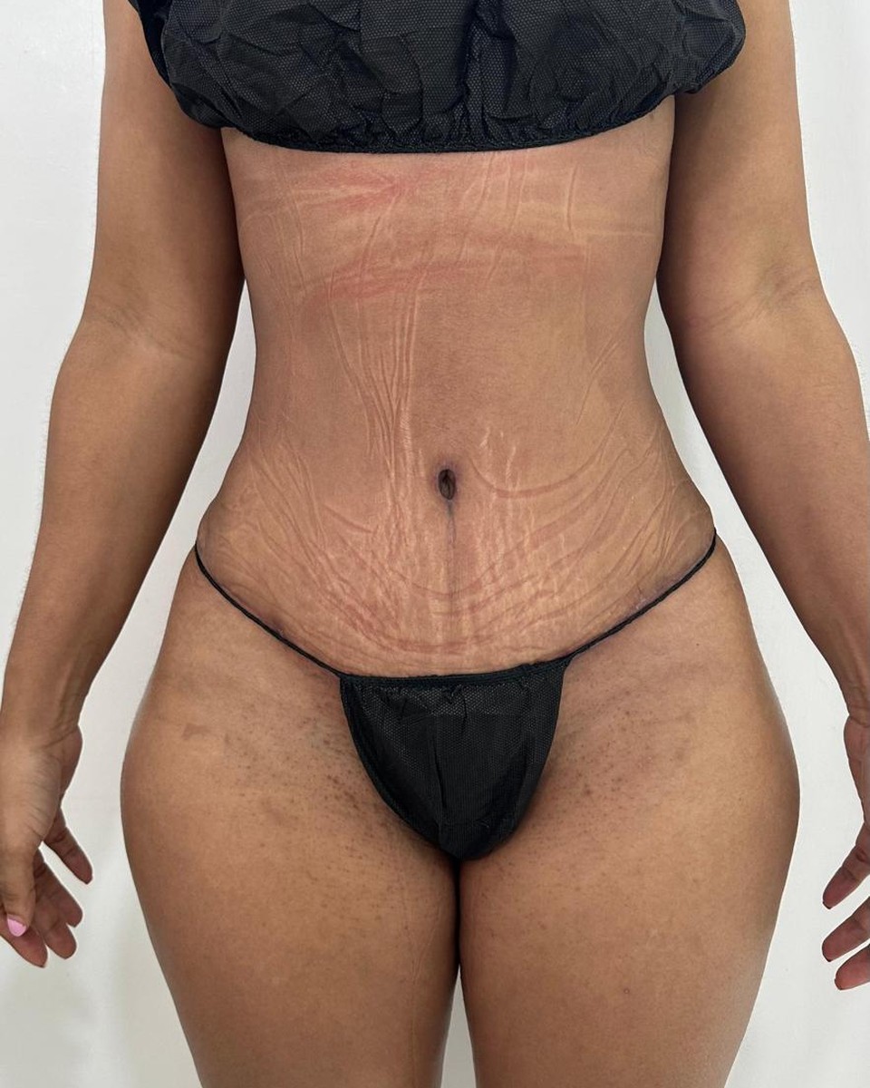 Abdominoplastia - Después #13